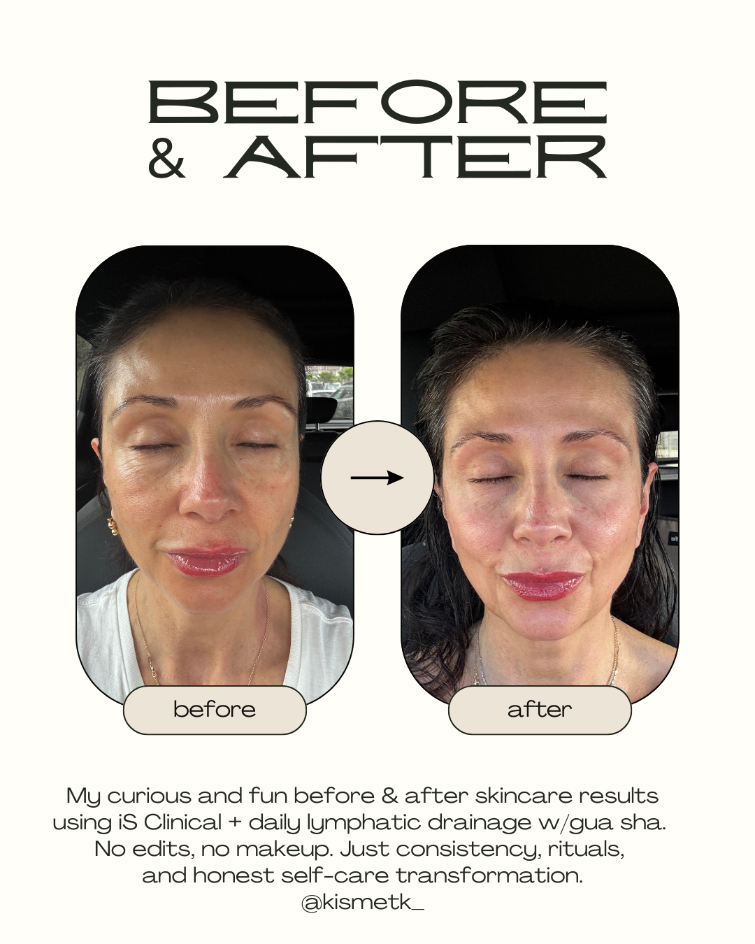 ✨ BEFORE & AFTERS: THE REAL STORY BEHIND MY 3–4 MONTH SKIN TRANSFORMATION