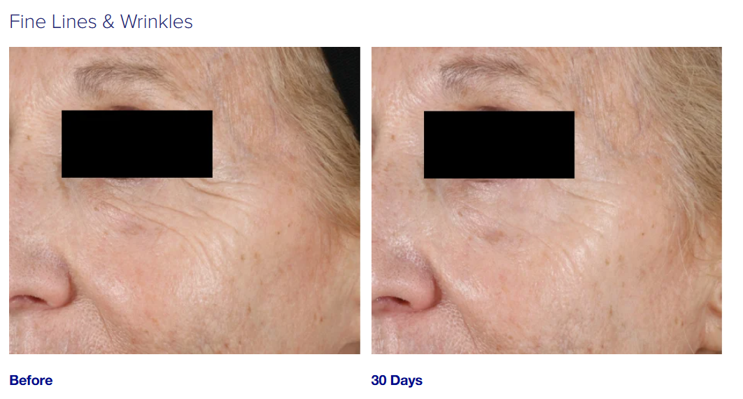 Best Eye Wrinkle Cream