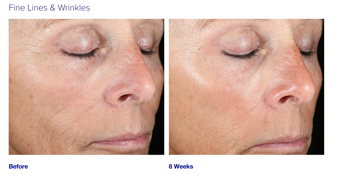 Glycolic Acid Face Peel for fine lines and wrinkles