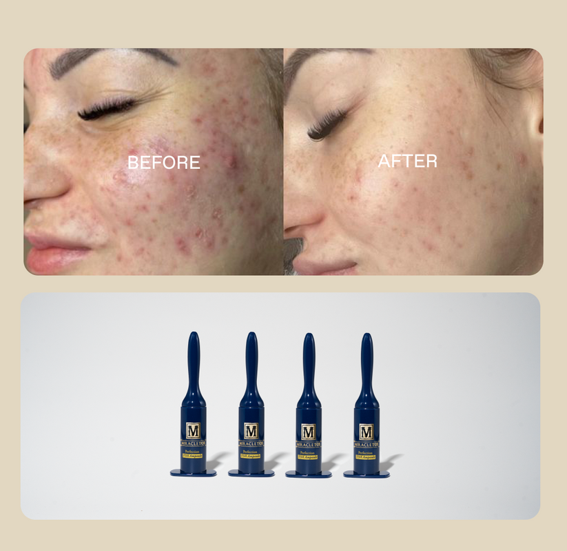 cellstory liquid micro needling before and after