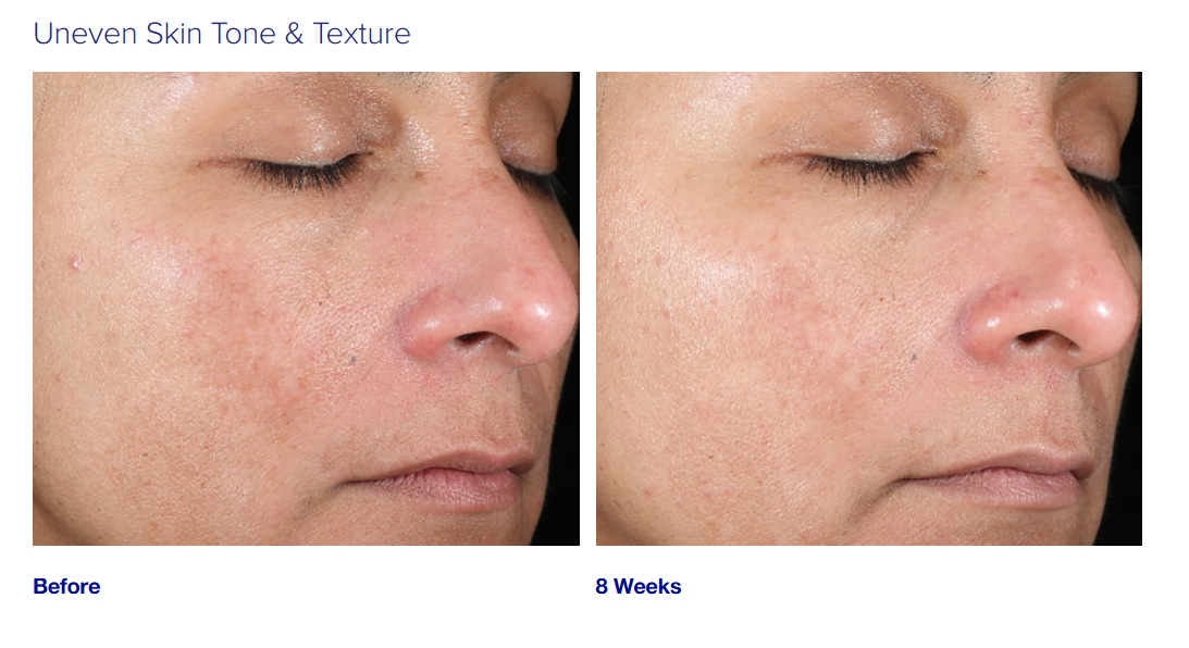 Glycolic Acid Face Peel for uneven skin tone and texture