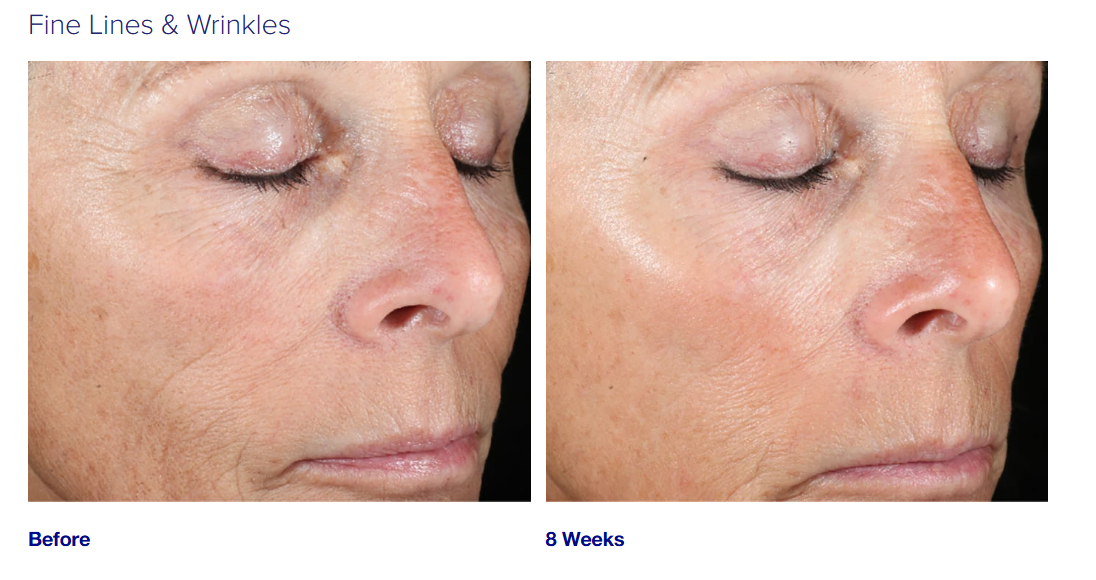 Glycolic Acid Face Peel for fine lines and wrinkles
