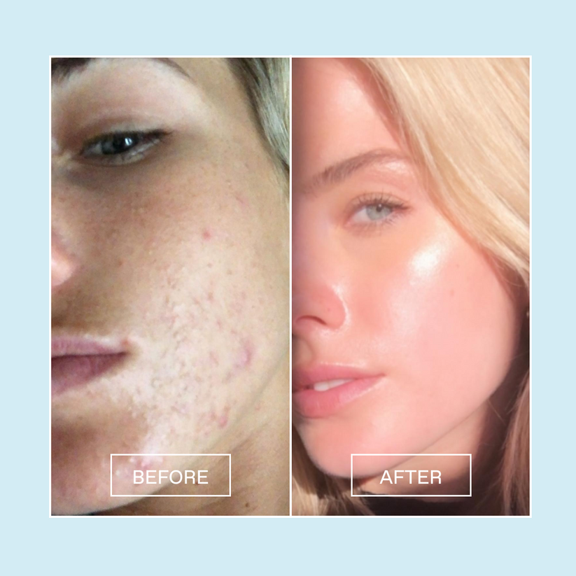 One Time Miracletox Facial