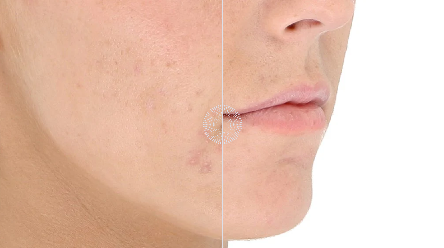 Lightstim for Acne before and afters
