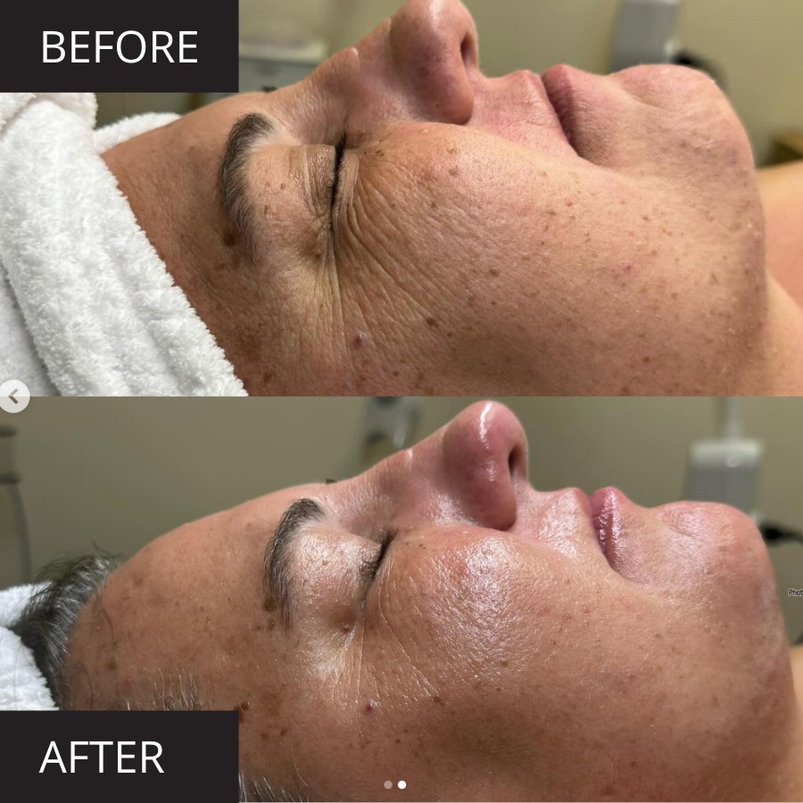 MyoLift™ Mini Home Care Kit Before and After