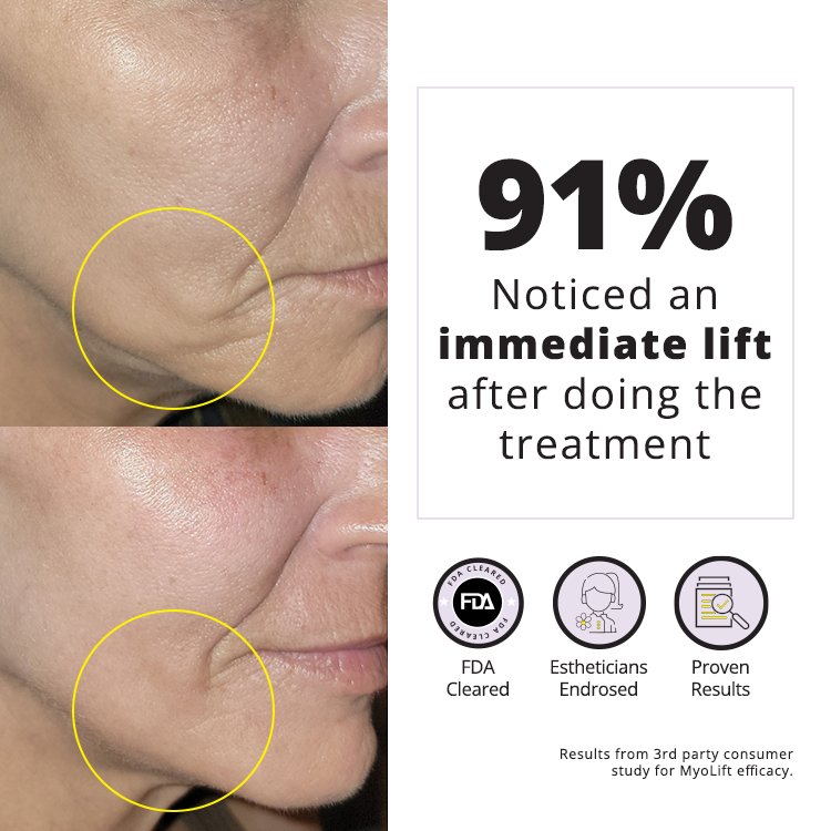 MyoLift™ QT Plus Facial Toning Device Before and After