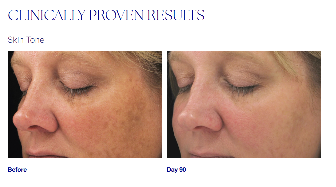 dark spot face cream, dark spot corrector by iS Clinical before and after results
